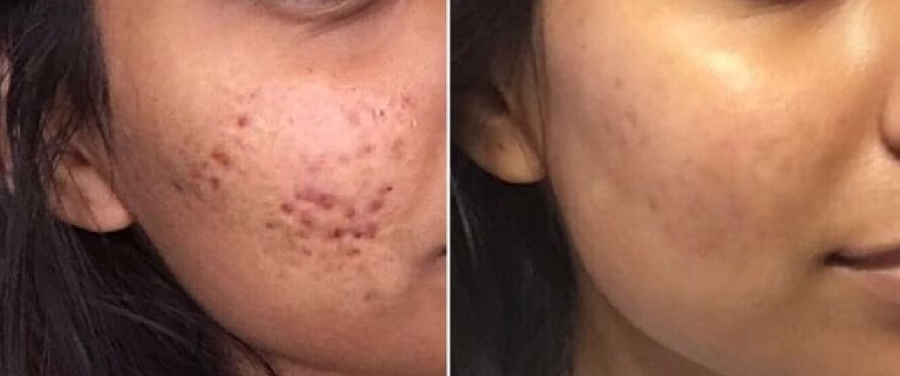 Acne Treatment Combo