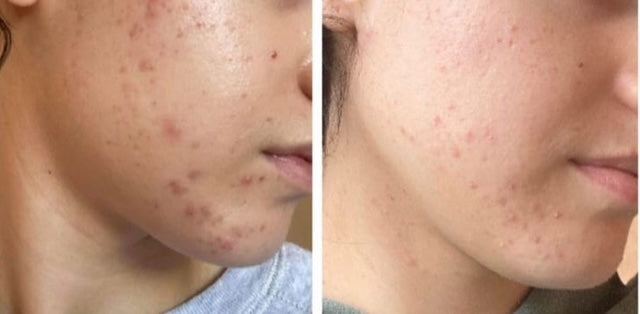 Acne Treatment Combo